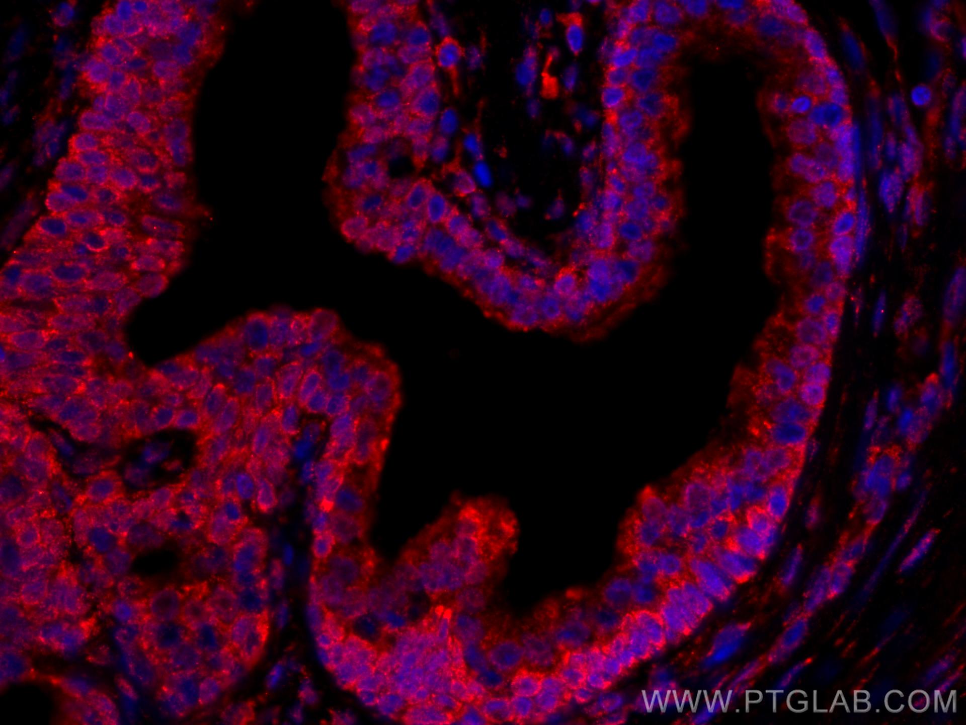 IF Staining of human prostate cancer using CL594-67451
