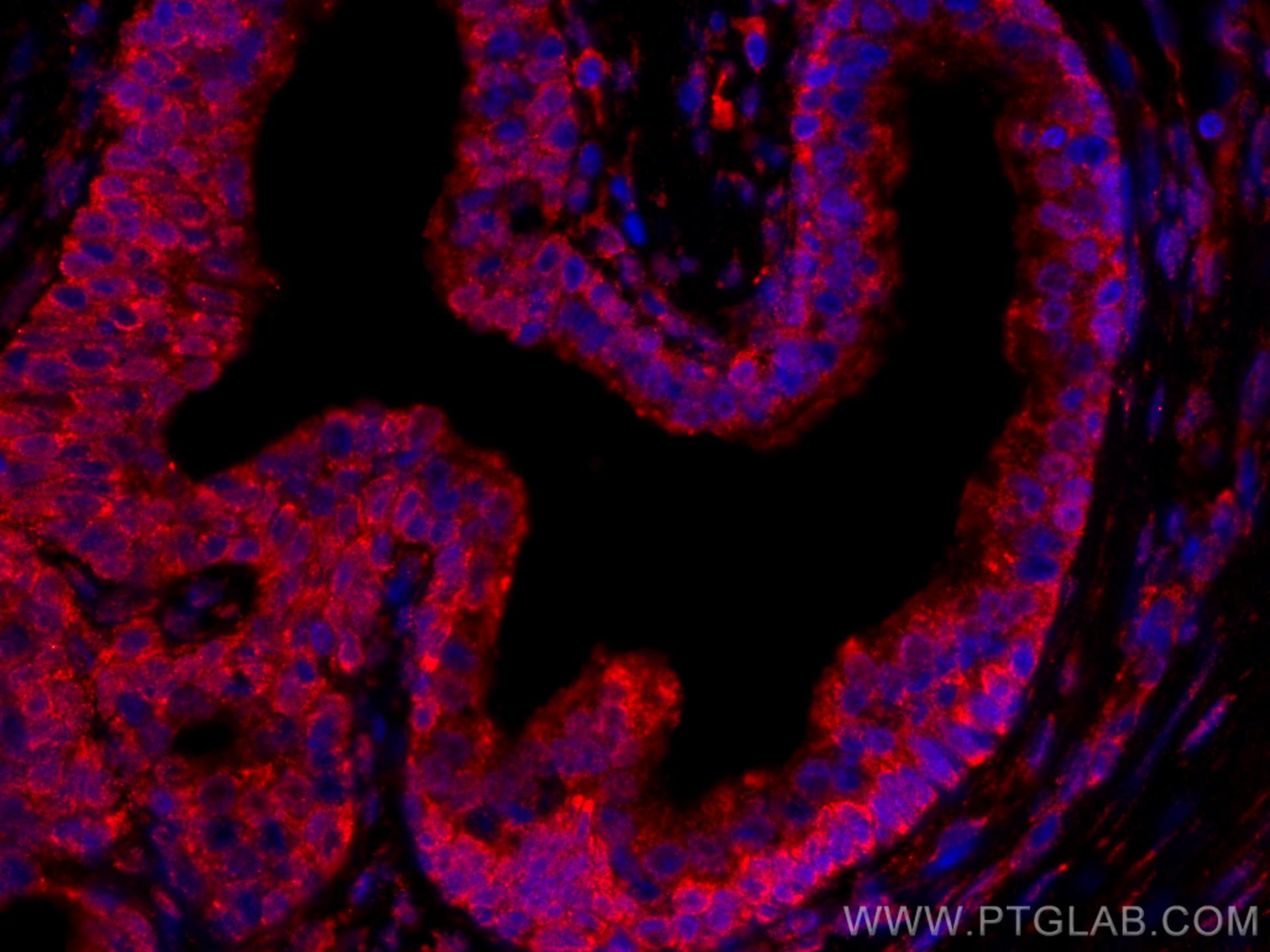 Immunofluorescence (IF) / fluorescent staining of human prostate cancer tissue using CoraLite®594-conjugated TAOK3 Monoclonal antibody (CL594-67451)