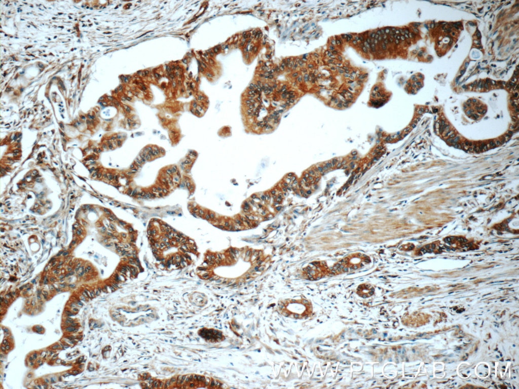Immunohistochemistry (IHC) staining of human pancreas cancer tissue using TAP1 Polyclonal antibody (11114-1-AP)