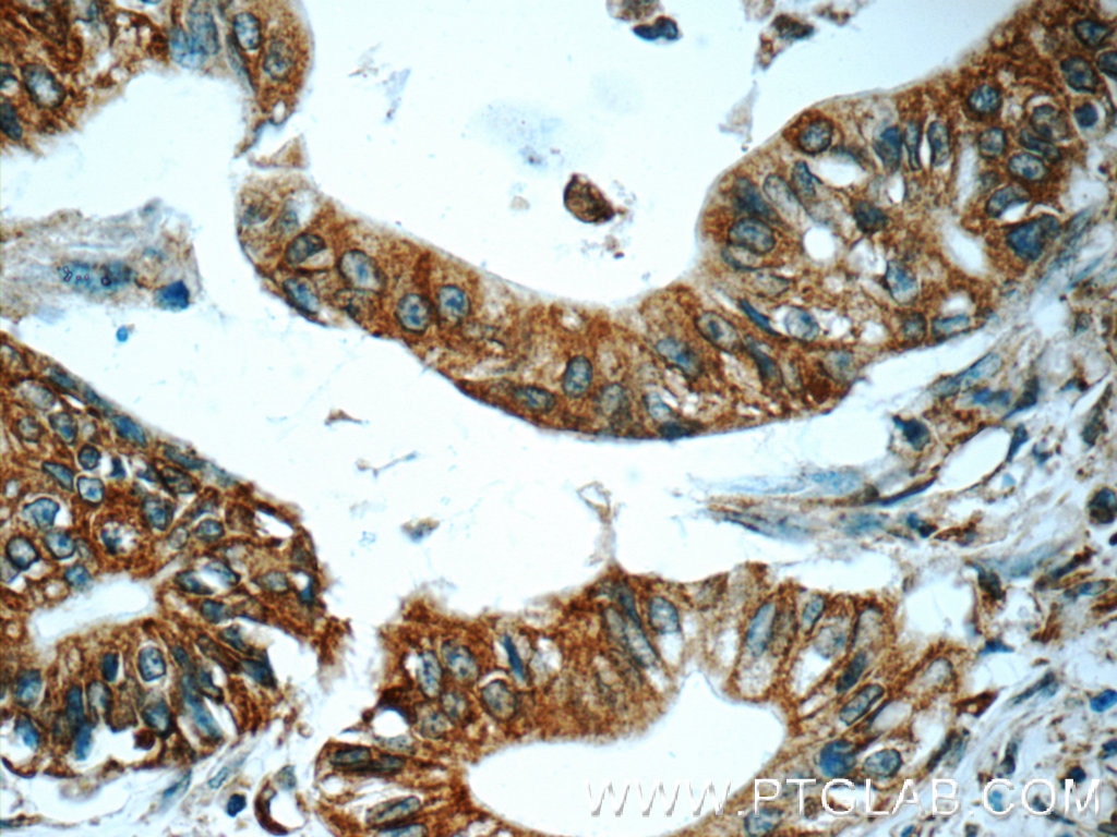 Immunohistochemistry (IHC) staining of human pancreas cancer tissue using TAP1 Polyclonal antibody (11114-1-AP)