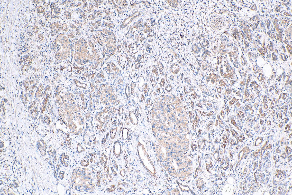 IHC staining of human pancreas cancer using 68412-1-Ig