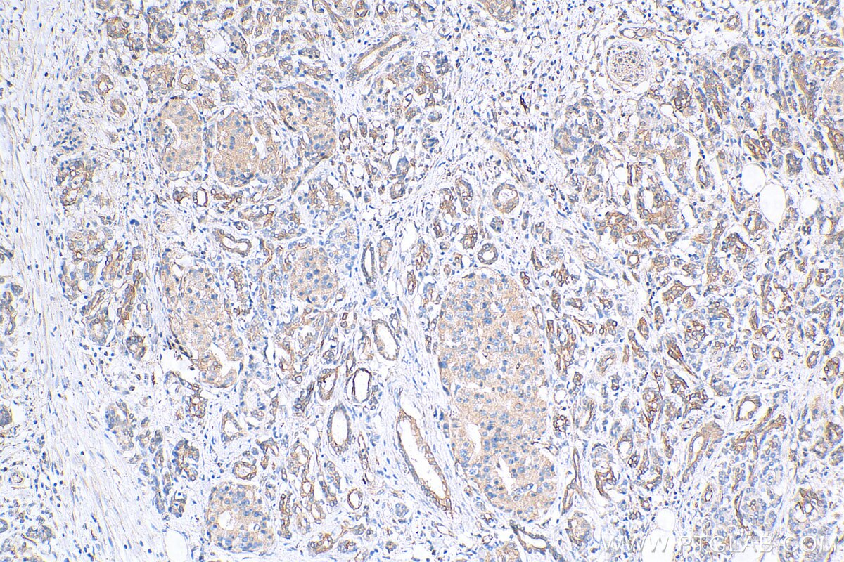 Immunohistochemistry (IHC) staining of human pancreas cancer tissue using TAP1 Monoclonal antibody (68412-1-Ig)