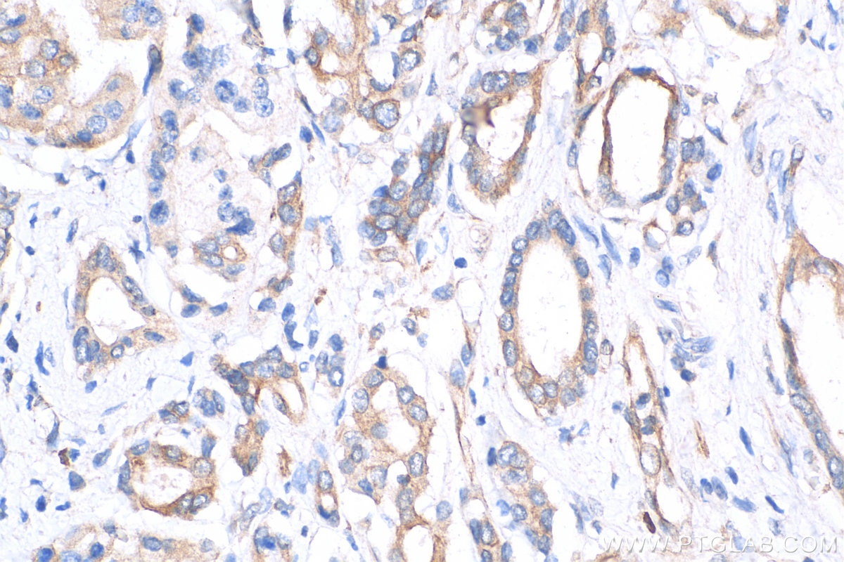 Immunohistochemistry (IHC) staining of human pancreas cancer tissue using TAP1 Monoclonal antibody (68412-1-Ig)