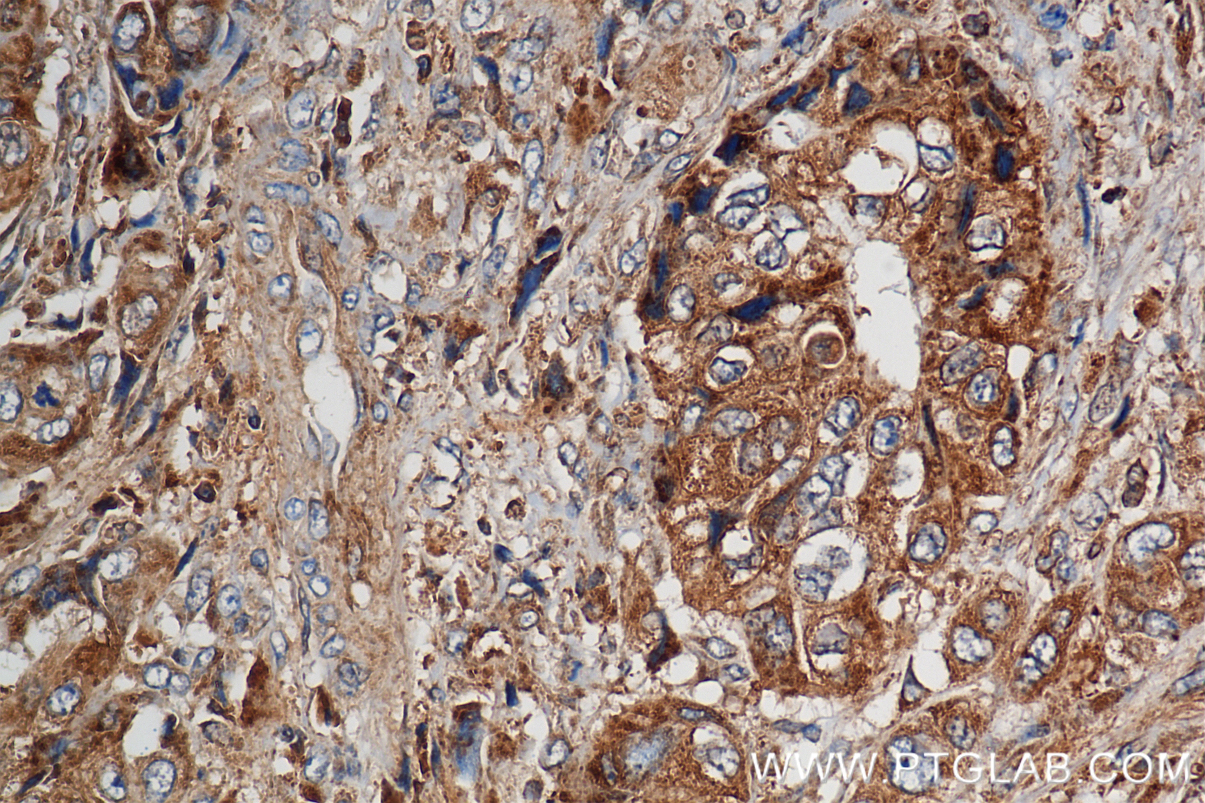 Immunohistochemistry (IHC) staining of human pancreas cancer tissue using TAP1 Recombinant antibody (85766-4-RR)