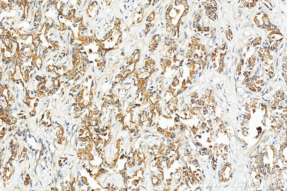 Immunohistochemistry (IHC) staining of human intrahepatic cholangiocarcinoma tissue using TAP2 Polyclonal antibody (10161-1-AP)
