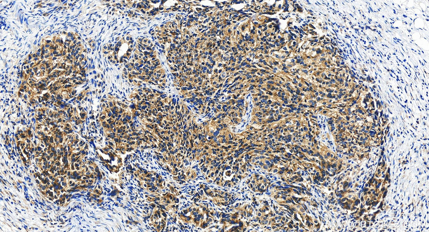 Immunohistochemistry (IHC) staining of human ovary cancer tissue using TAP2 Polyclonal antibody (10161-1-AP)