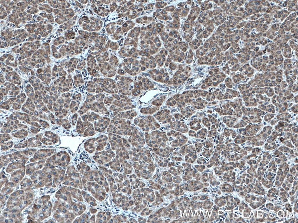 Immunohistochemistry (IHC) staining of human liver cancer tissue using TAPT1 Polyclonal antibody (27657-1-AP)