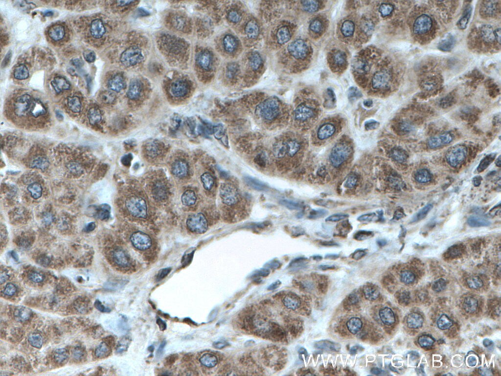 Immunohistochemistry (IHC) staining of human liver cancer tissue using TAPT1 Polyclonal antibody (27657-1-AP)