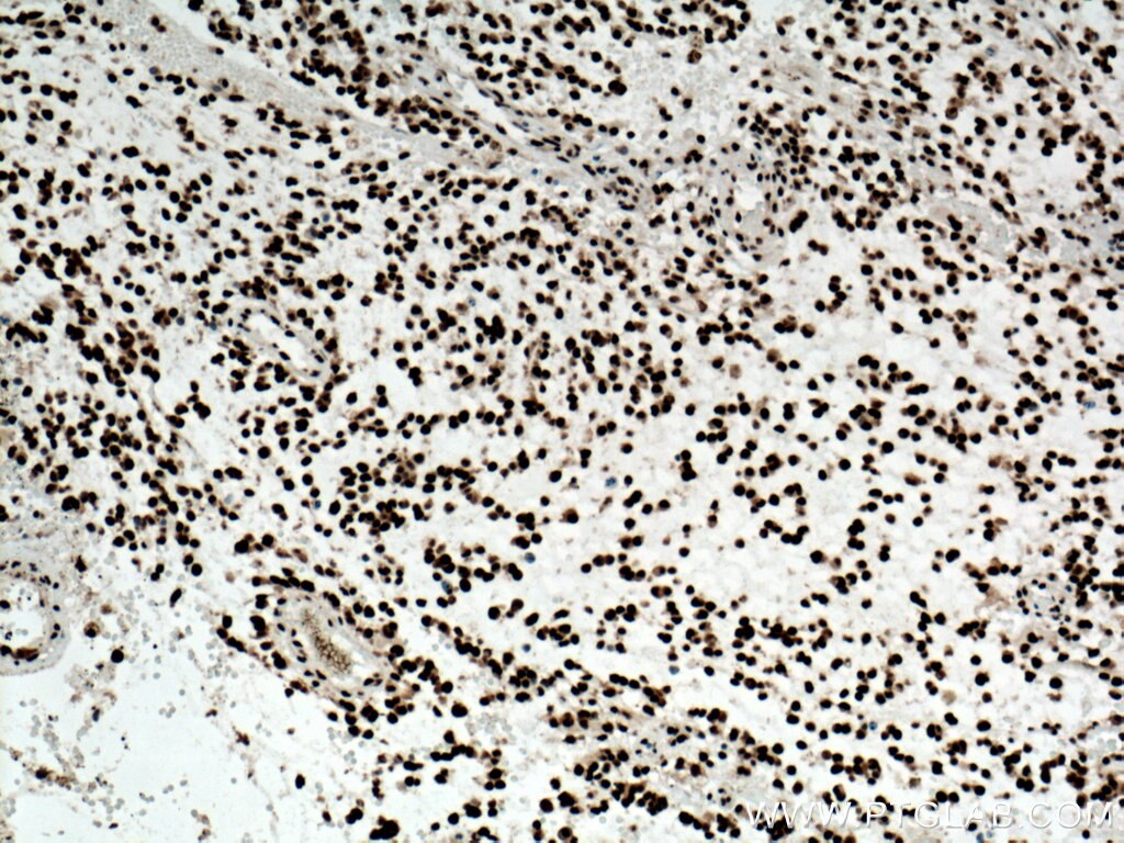 IHC staining of human gliomas using 10782-2-AP