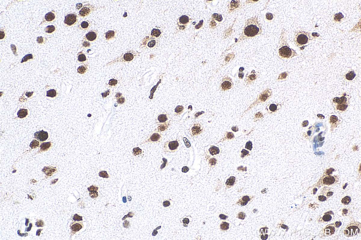 Immunohistochemistry (IHC) staining of human gliomas tissue using TDP-43 Polyclonal antibody (10782-2-AP)