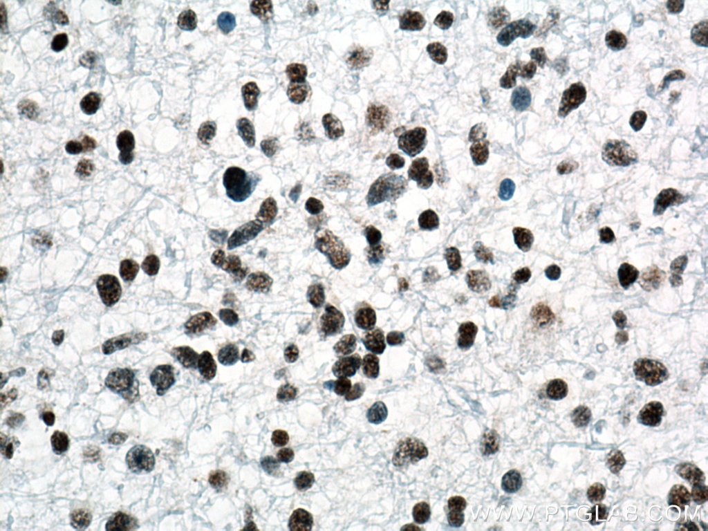 Immunohistochemistry (IHC) staining of human gliomas tissue using TDP-43 (C-terminal) Polyclonal antibody (12892-1-AP)