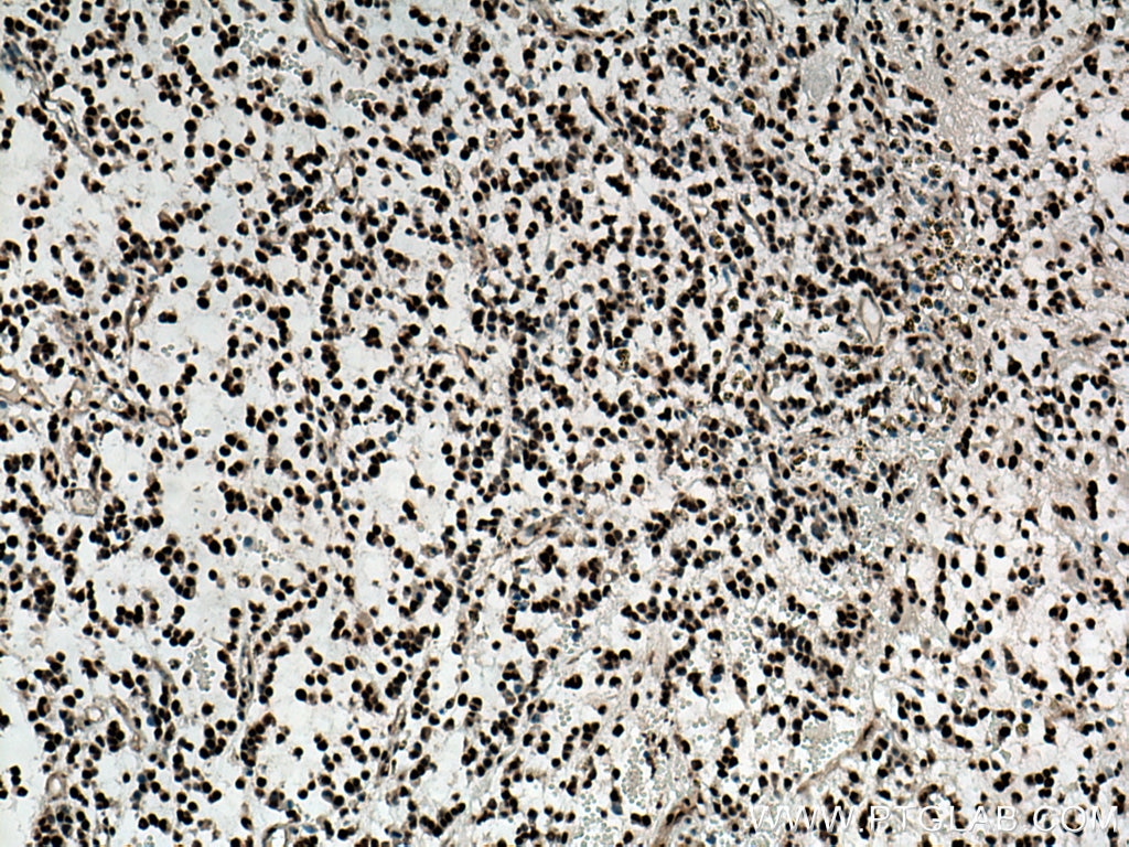 Immunohistochemistry (IHC) staining of human gliomas tissue using TDP-43 Polyclonal antibody (18280-1-AP)