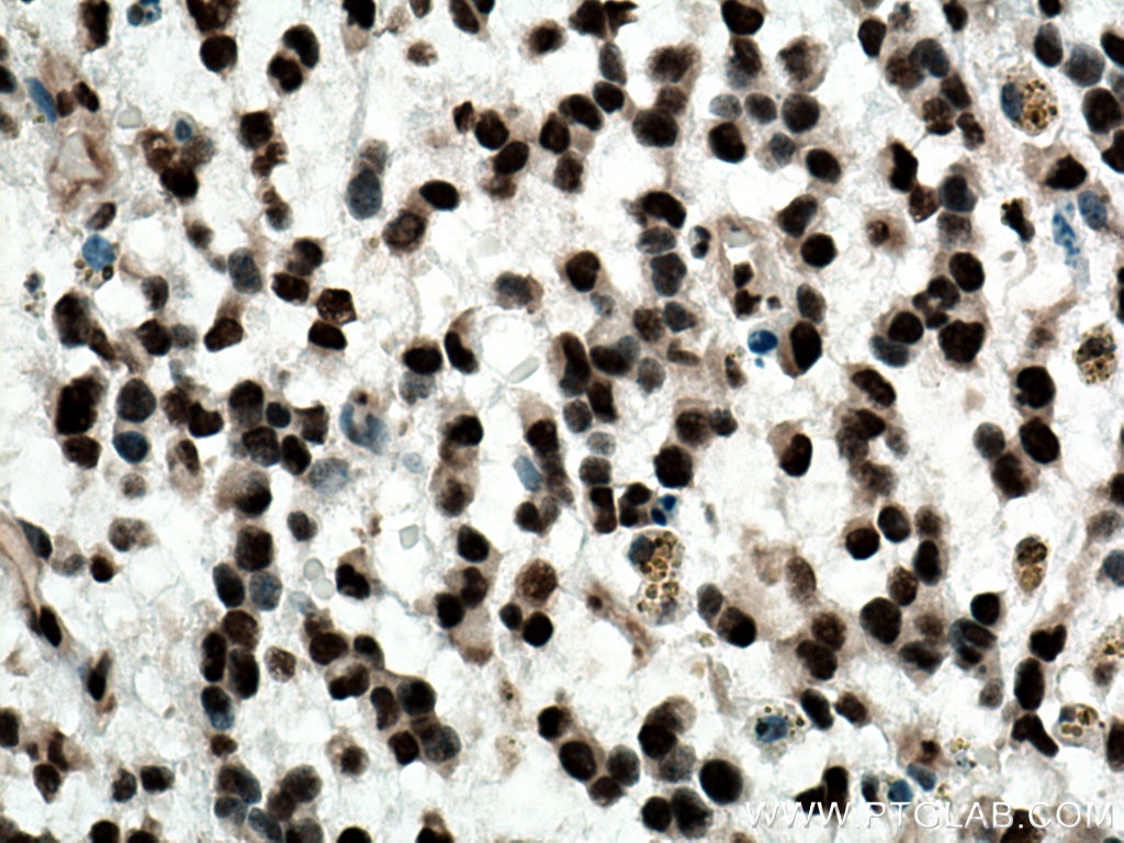 Immunohistochemistry (IHC) staining of human gliomas tissue using TDP-43 Polyclonal antibody (18280-1-AP)