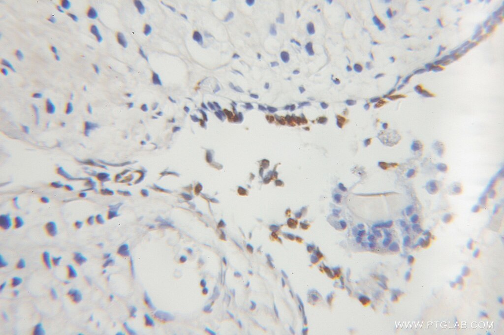 Immunohistochemistry (IHC) staining of human prostate cancer tissue using TDP-43 Monoclonal antibody (60019-1-Ig)