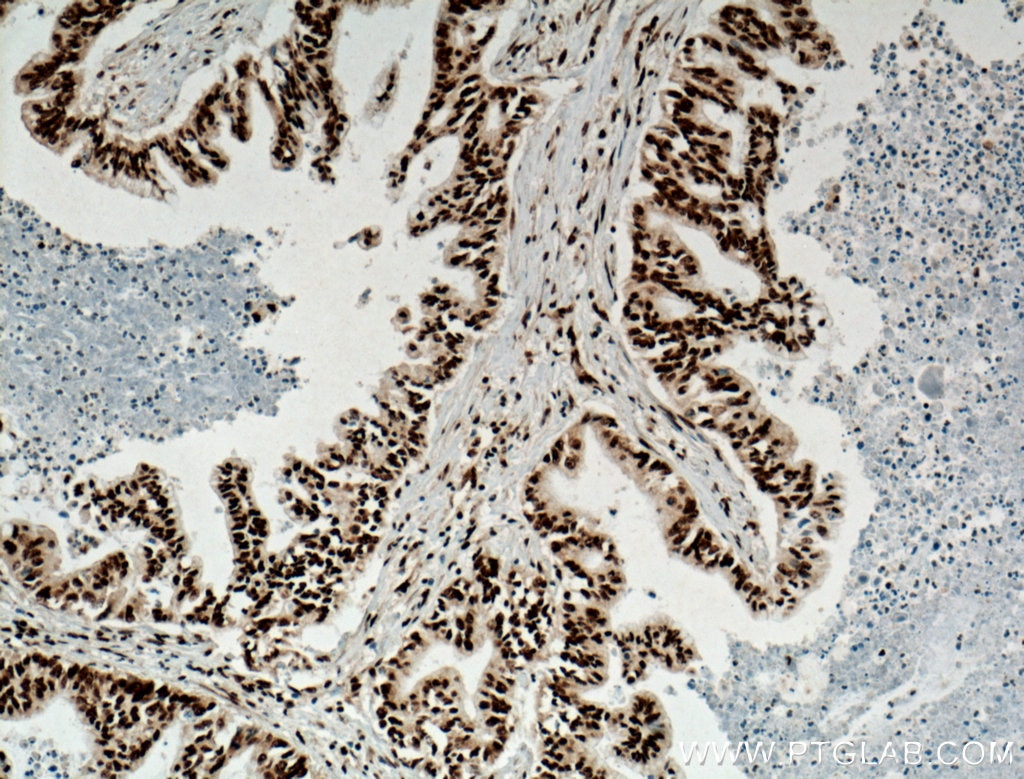 Immunohistochemistry (IHC) staining of human pancreas cancer tissue using TDP-43 (human specific) Monoclonal antibody (60019-2-Ig)
