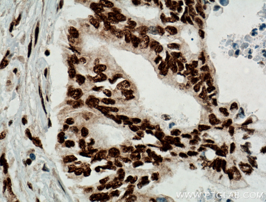 Immunohistochemistry (IHC) staining of human pancreas cancer tissue using TDP-43 (human specific) Monoclonal antibody (60019-2-Ig)