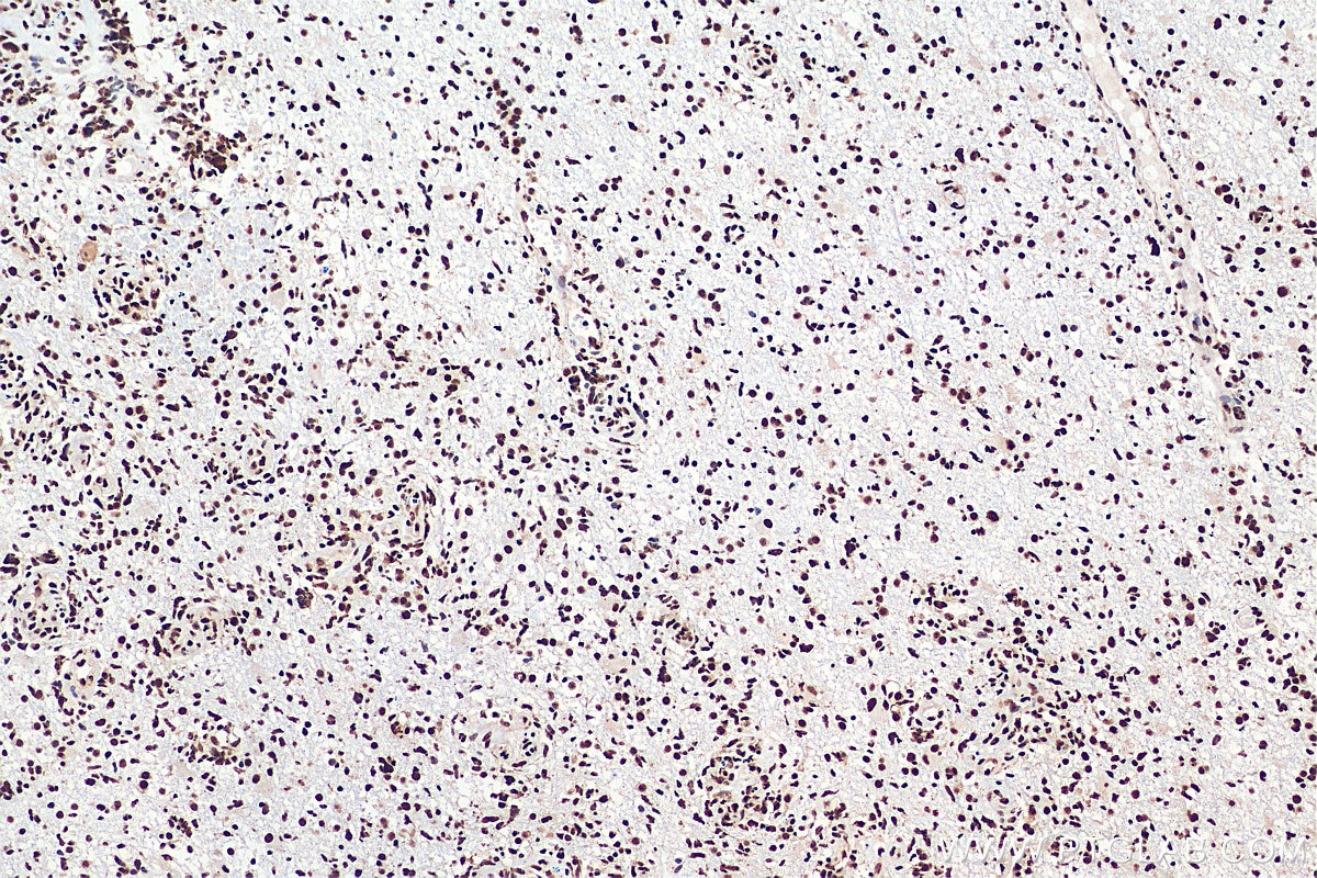 Immunohistochemistry (IHC) staining of human gliomas tissue using TDP-43 (human specific) Monoclonal antibody (60019-2-Ig)