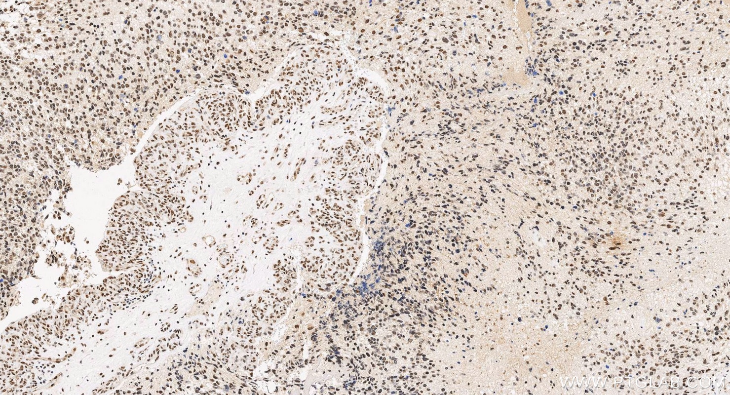 IHC staining of human gliomas using 60019-2-Ig (same clone as 60019-2-PBS) Immunohistochemistry (IHC) staining of human gliomas tissue using TDP-43 (human specific) Monoclonal antibody (60019-2-Ig)