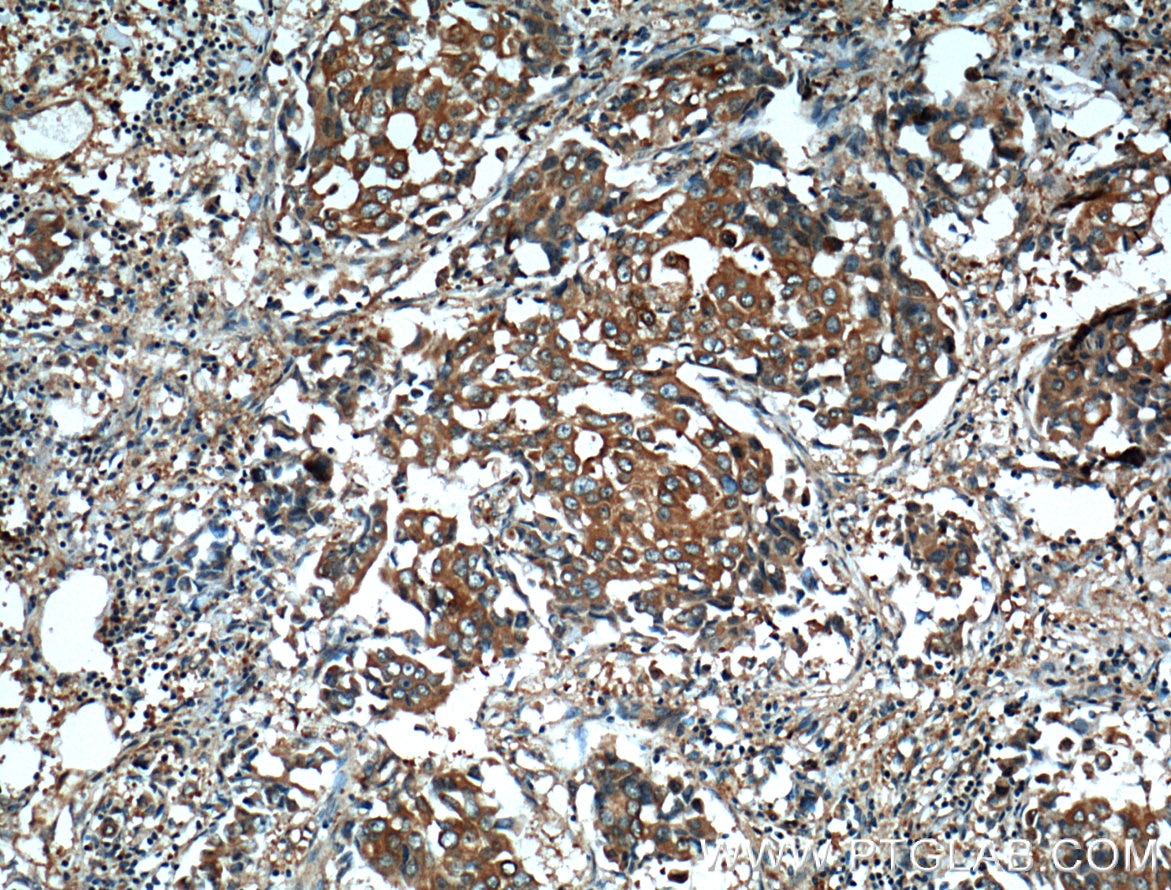 Immunohistochemistry (IHC) staining of human breast cancer tissue using TARS Polyclonal antibody (14773-1-AP)