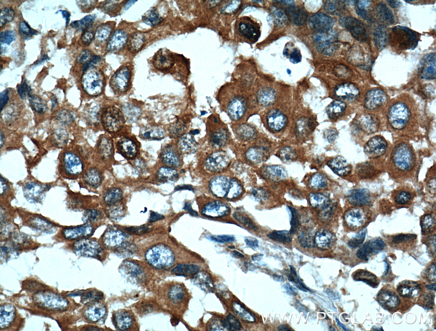 Immunohistochemistry (IHC) staining of human breast cancer tissue using TARS Polyclonal antibody (14773-1-AP)