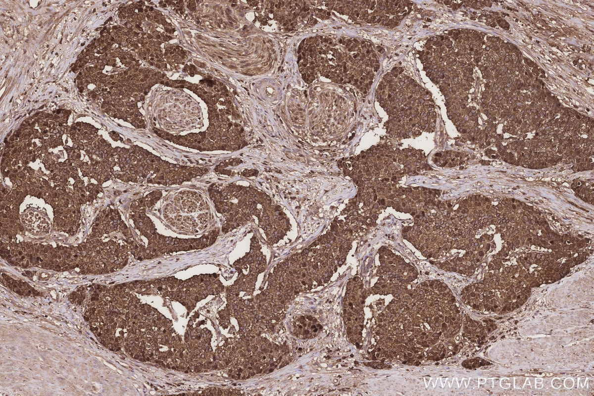 IHC staining of human stomach cancer using 67828-1-Ig Immunohistochemistry (IHC) staining of human stomach cancer tissue using TARS Monoclonal antibody (67828-1-Ig)