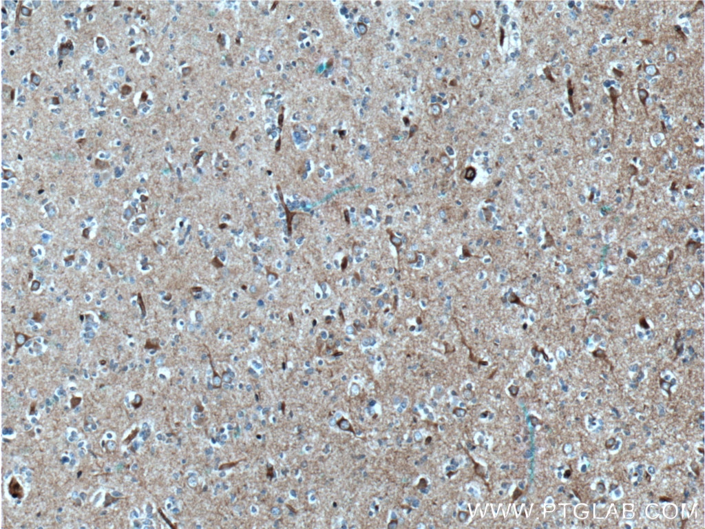 Immunohistochemistry (IHC) staining of human gliomas tissue using TAU Monoclonal antibody (66499-1-Ig)