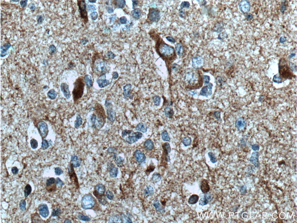 Immunohistochemistry (IHC) staining of human gliomas tissue using TAU Monoclonal antibody (66499-1-Ig)