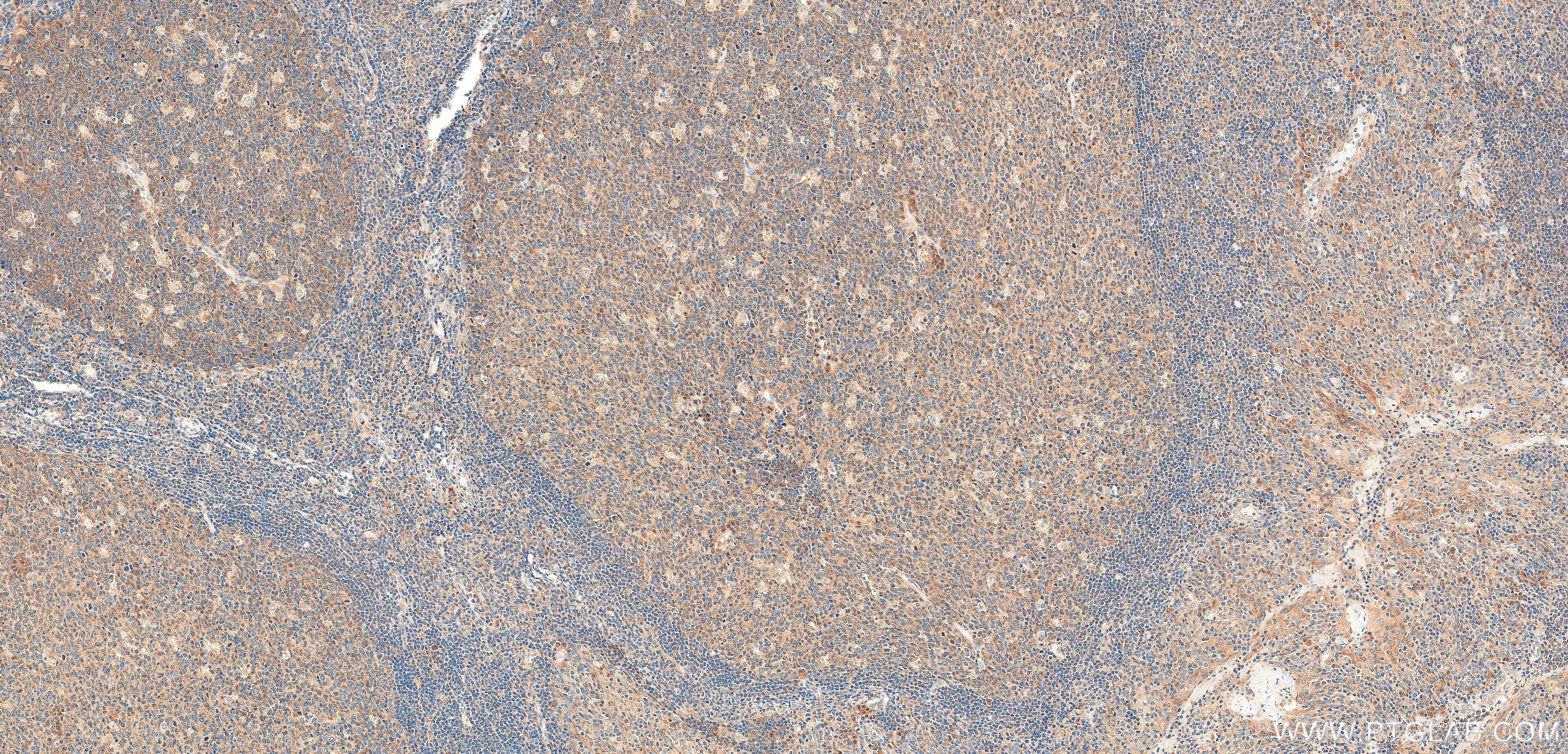 Immunohistochemistry (IHC) staining of human tonsil tissue using TAX1BP1 Recombinant monoclonal antibody (86602-3-RR)