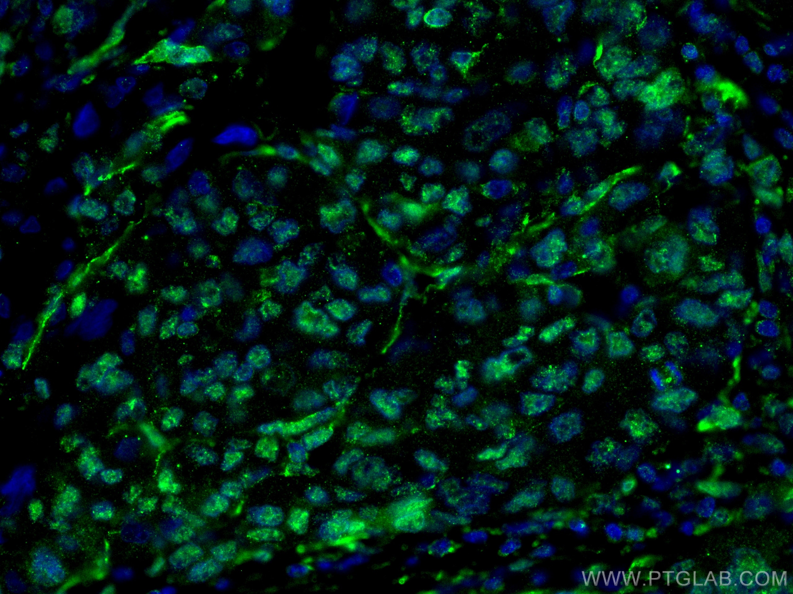 Immunofluorescence (IF) / fluorescent staining of human liver cancer tissue using WWTR1 Monoclonal antibody (66500-1-Ig)