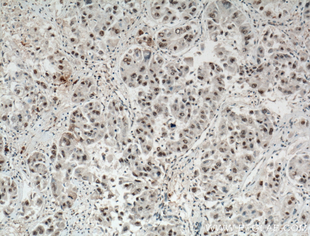 Immunohistochemistry (IHC) staining of human liver cancer tissue using WWTR1 Monoclonal antibody (66500-1-Ig)