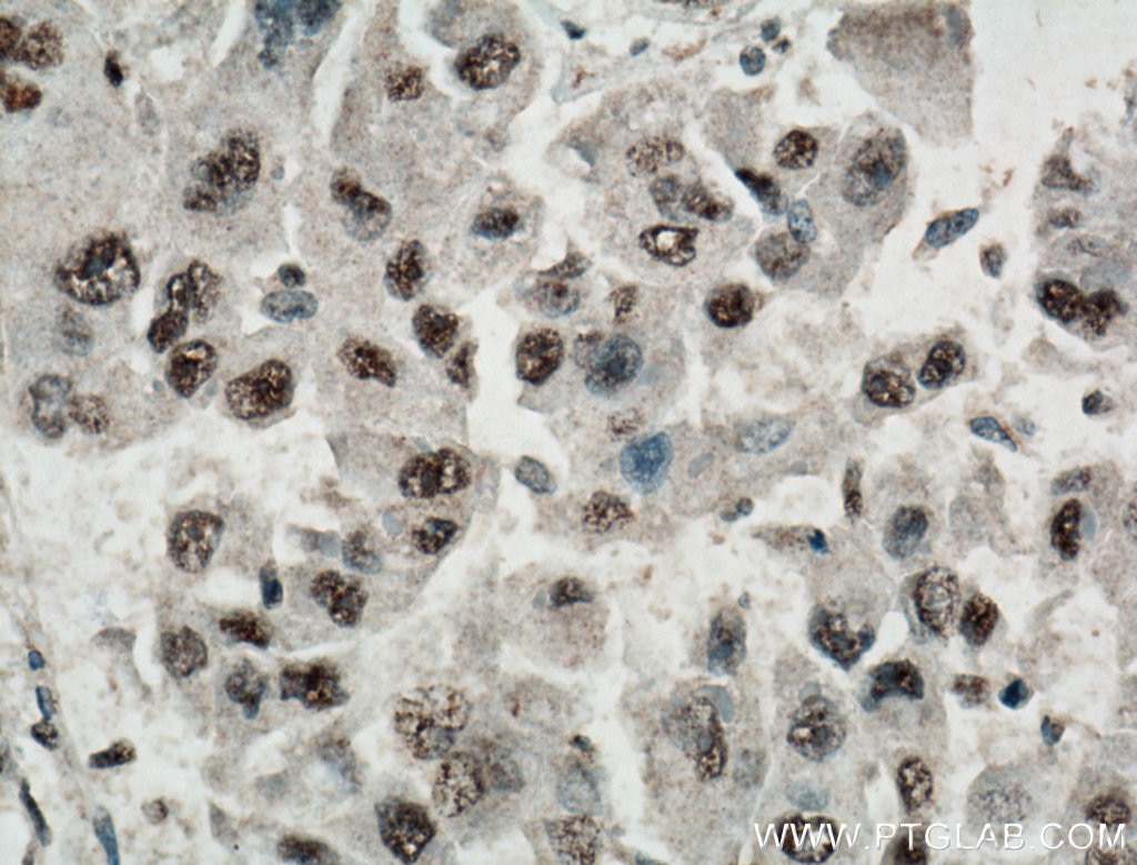 Immunohistochemistry (IHC) staining of human liver cancer tissue using WWTR1 Monoclonal antibody (66500-1-Ig)