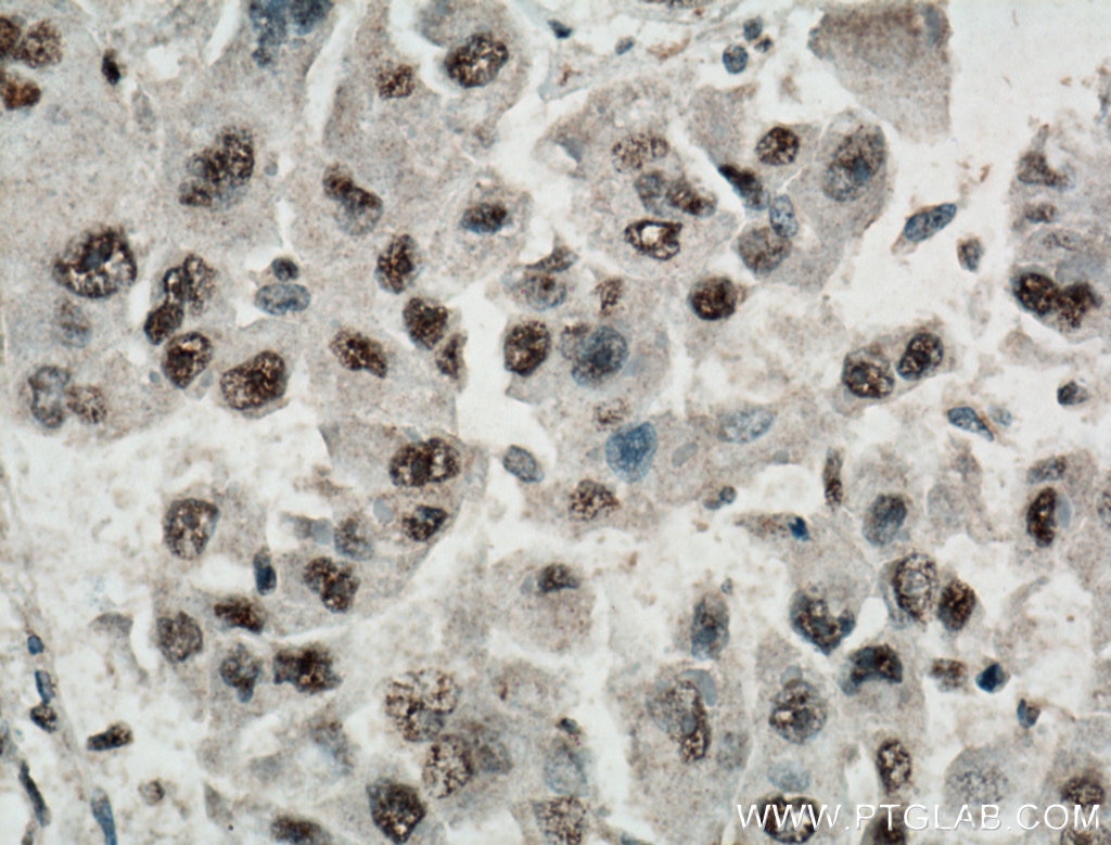 IHC staining of human liver cancer using 66500-1-Ig