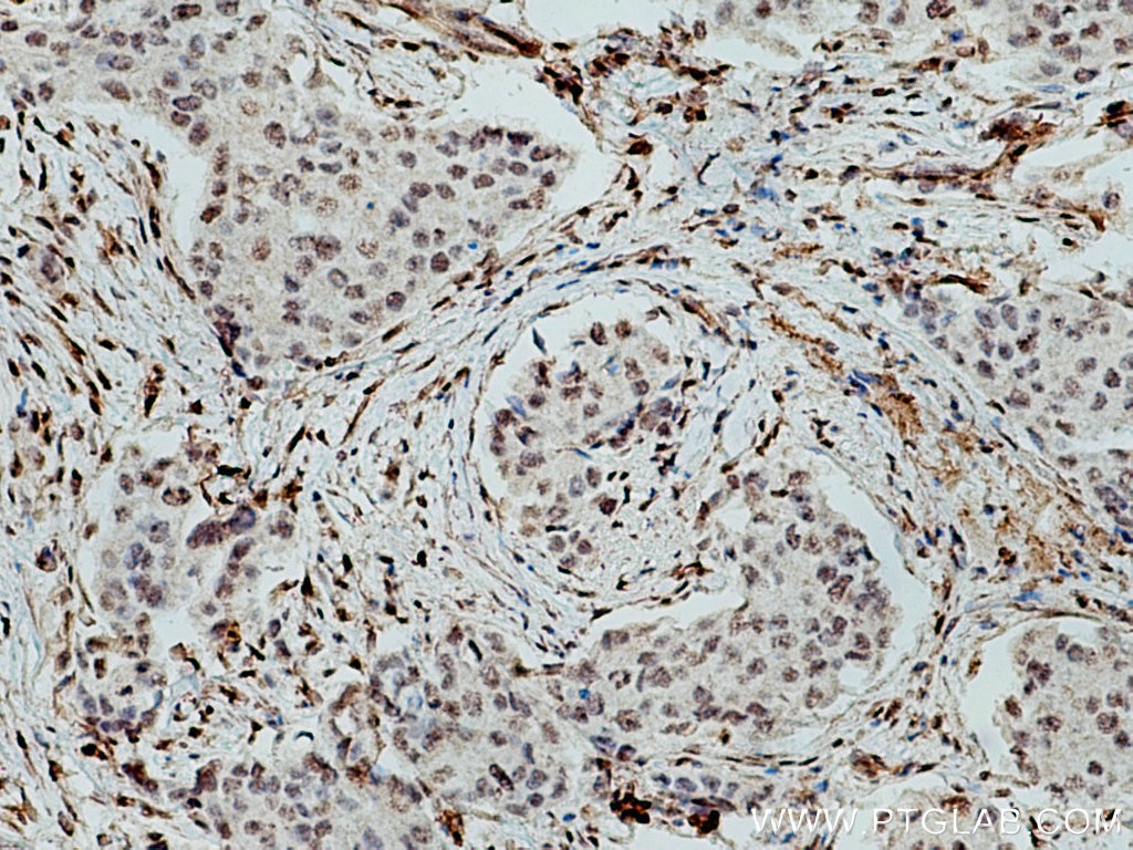 Immunohistochemistry (IHC) staining of human breast cancer tissue using WWTR1 Monoclonal antibody (66500-1-Ig)