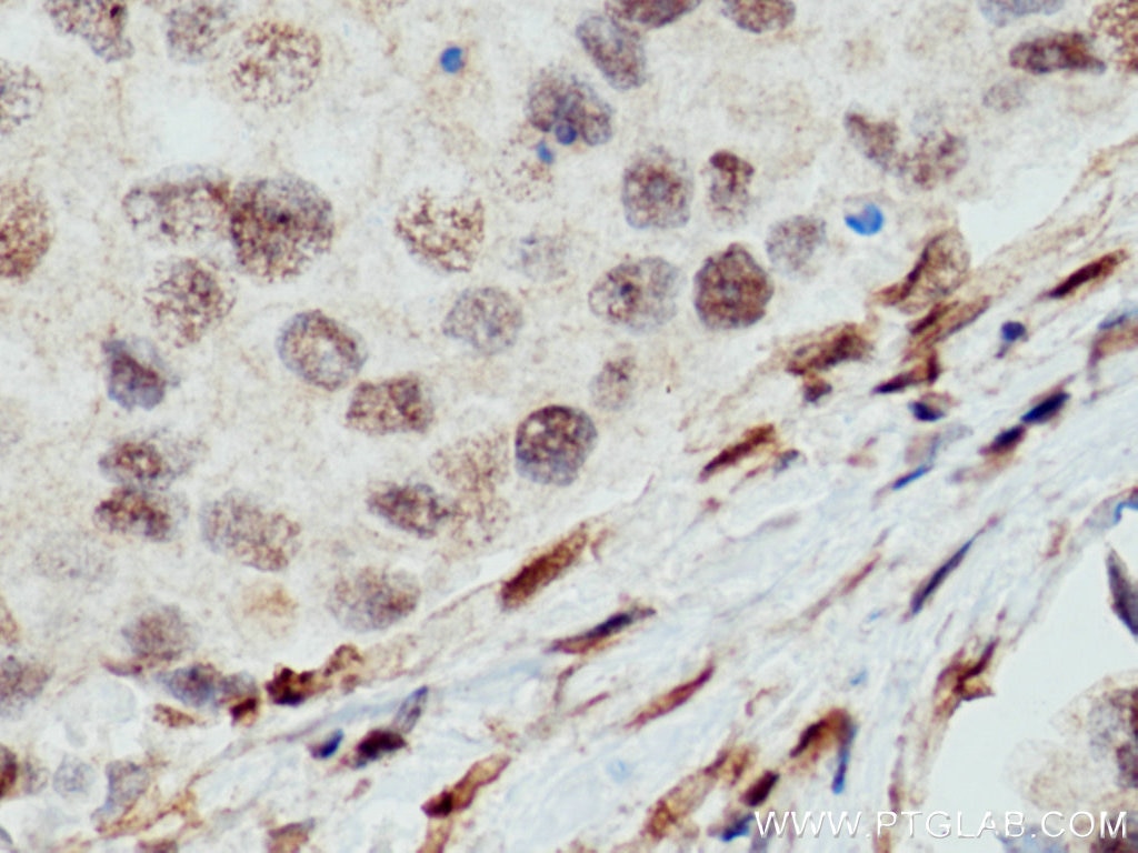 Immunohistochemistry (IHC) staining of human breast cancer tissue using WWTR1 Monoclonal antibody (66500-1-Ig)
