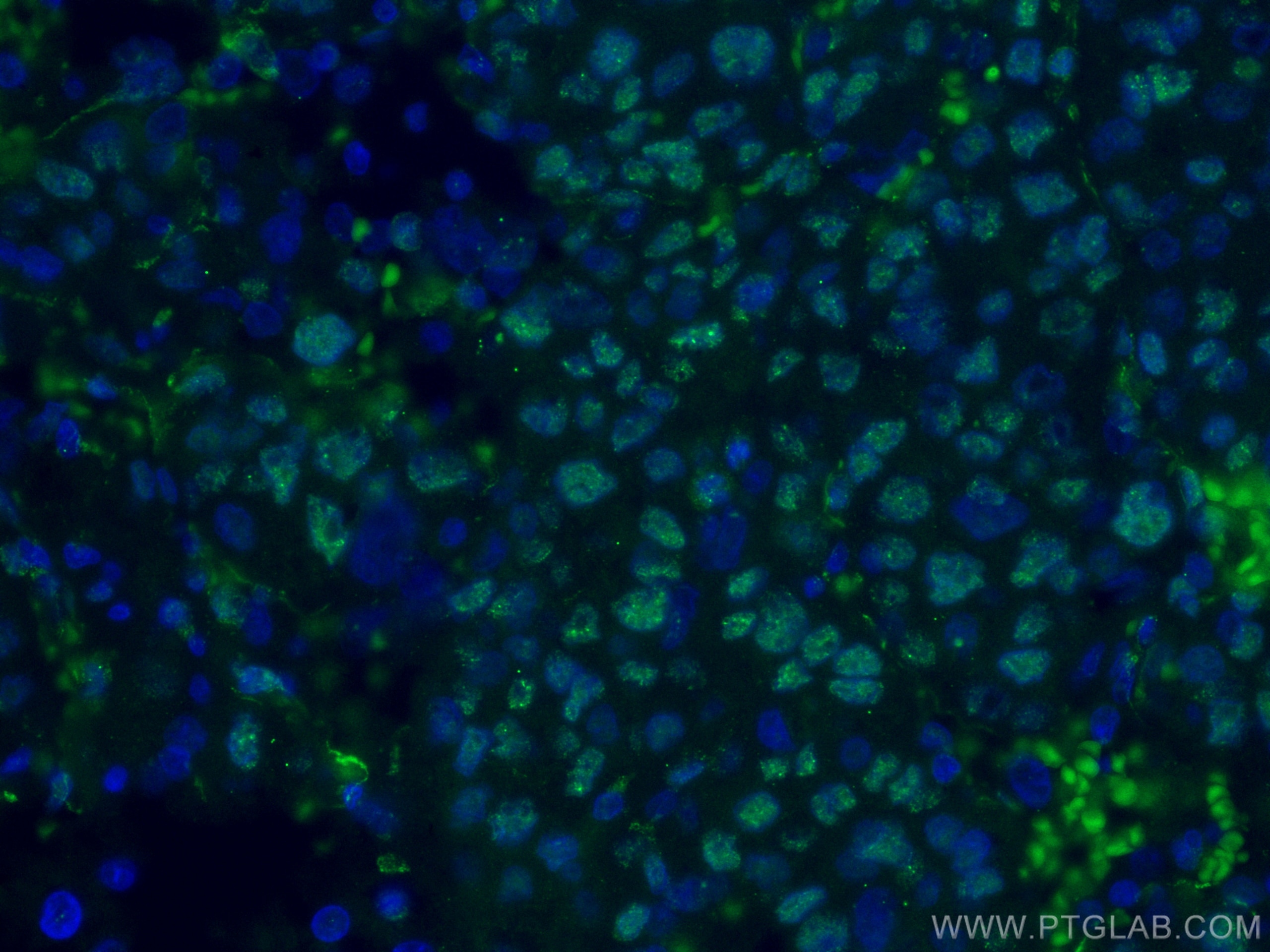 Immunofluorescence (IF) / fluorescent staining of human liver cancer tissue using CoraLite® Plus 488-conjugated WWTR1 Monoclonal ant (CL488-66500)