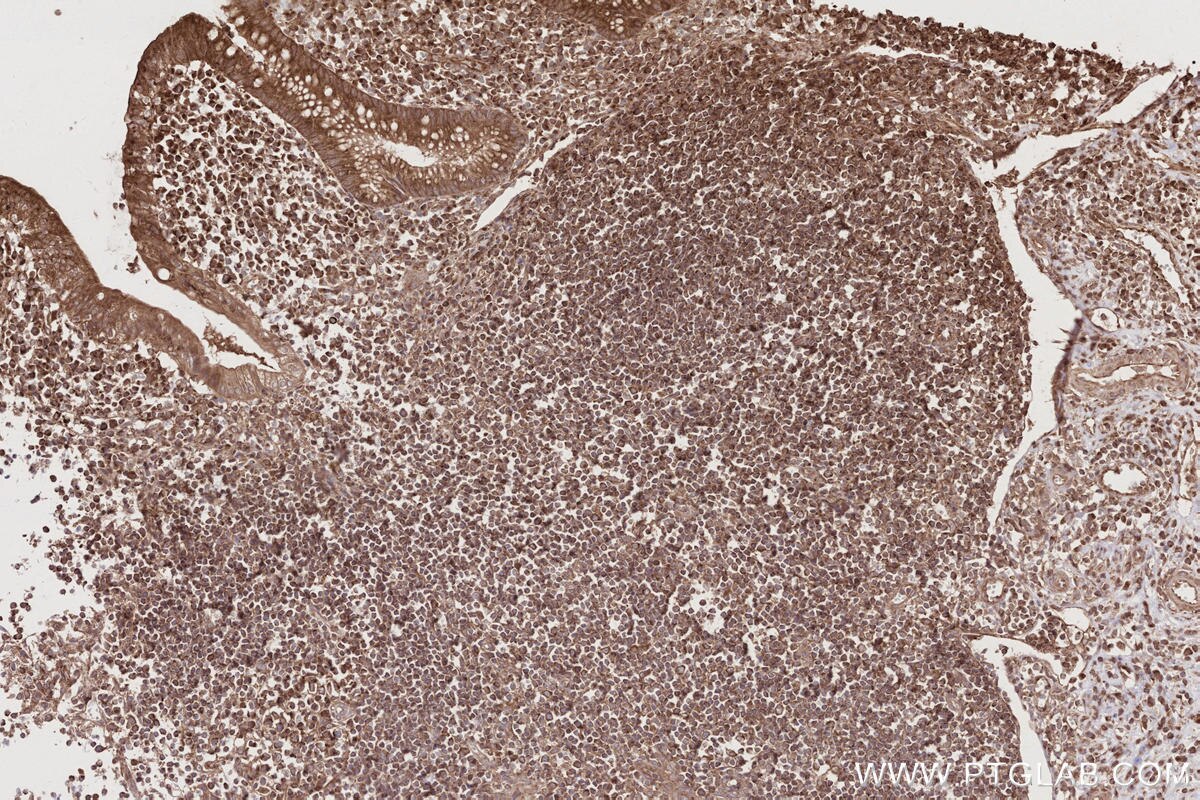 IHC staining of human appendicitis using 17252-1-AP Immunohistochemistry (IHC) staining of human appendicitis tissue using TBC1D15 Polyclonal antibody (17252-1-AP)