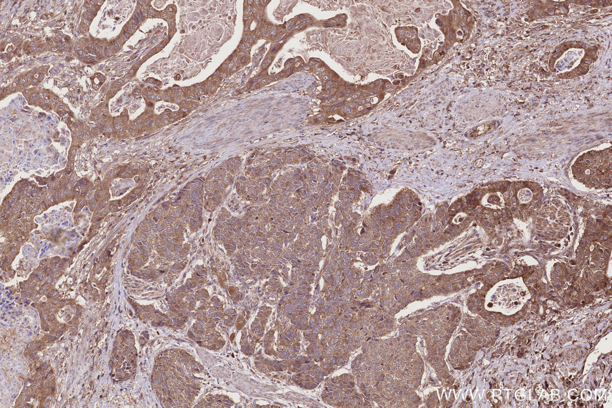 IHC staining of human stomach cancer using 17252-1-AP Immunohistochemistry (IHC) staining of human stomach cancer tissue using TBC1D15 Polyclonal antibody (17252-1-AP)