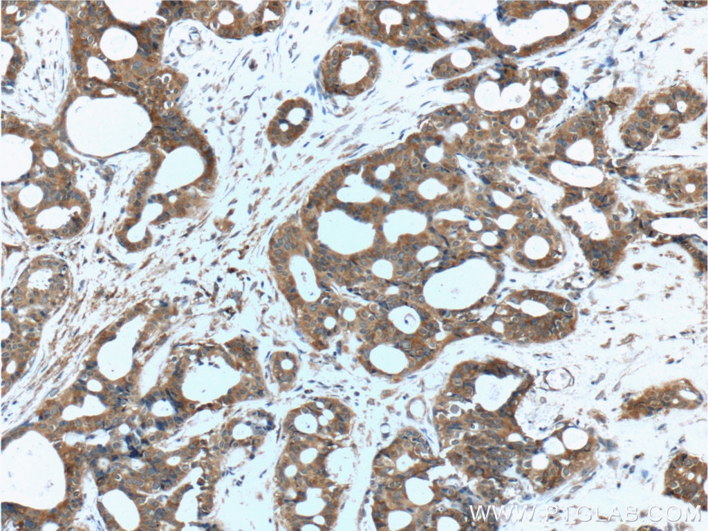 Immunohistochemistry (IHC) staining of human breast cancer tissue using TBC1D17 Polyclonal antibody (20482-1-AP)