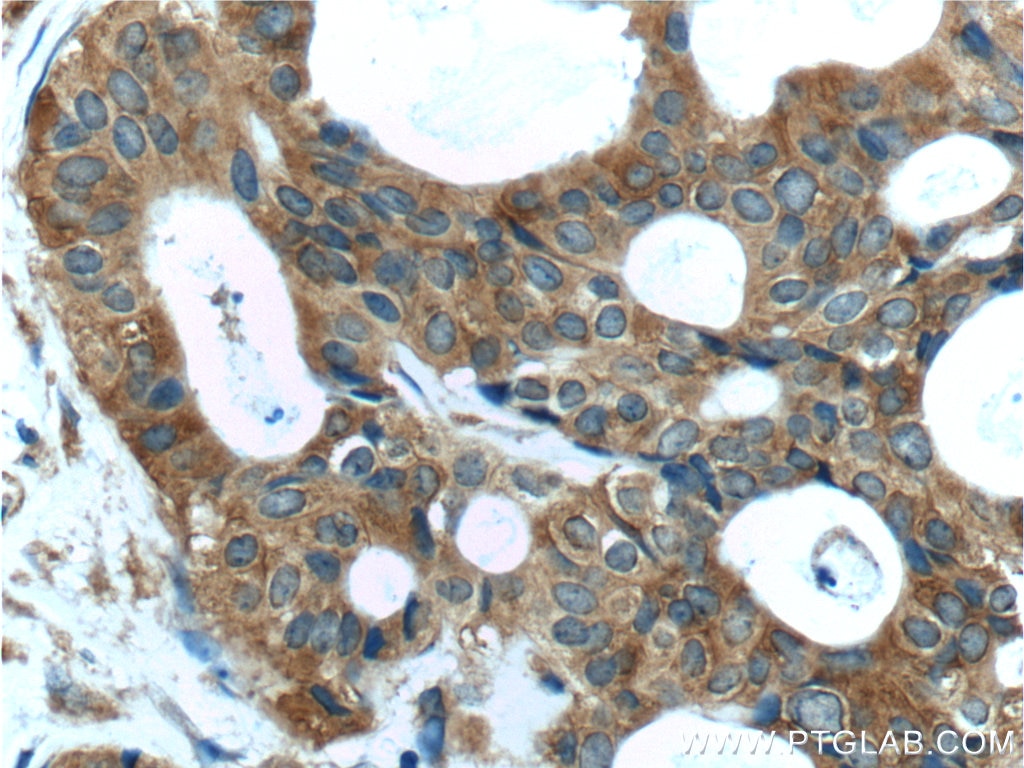 IHC staining of human breast cancer using 20482-1-AP