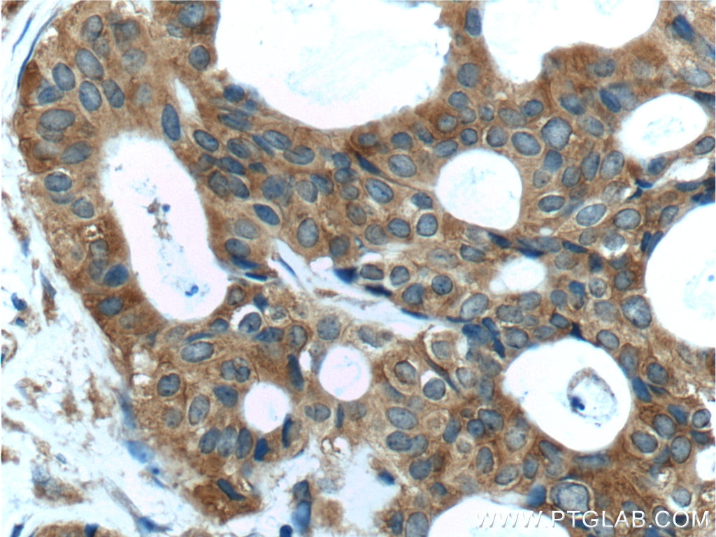 Immunohistochemistry (IHC) staining of human breast cancer tissue using TBC1D17 Polyclonal antibody (20482-1-AP)