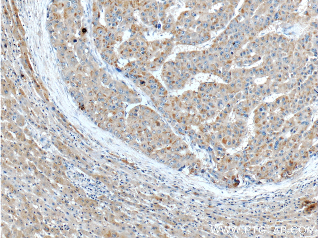 IHC staining of human liver cancer using 20482-1-AP