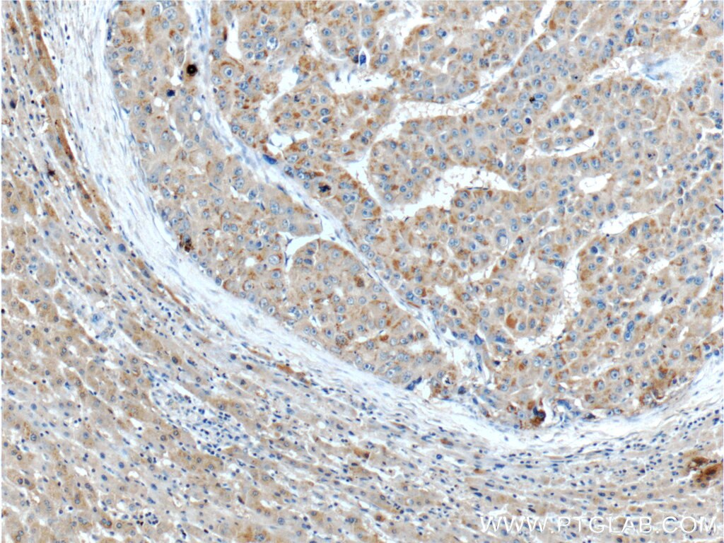 Immunohistochemistry (IHC) staining of human liver cancer tissue using TBC1D17 Polyclonal antibody (20482-1-AP)