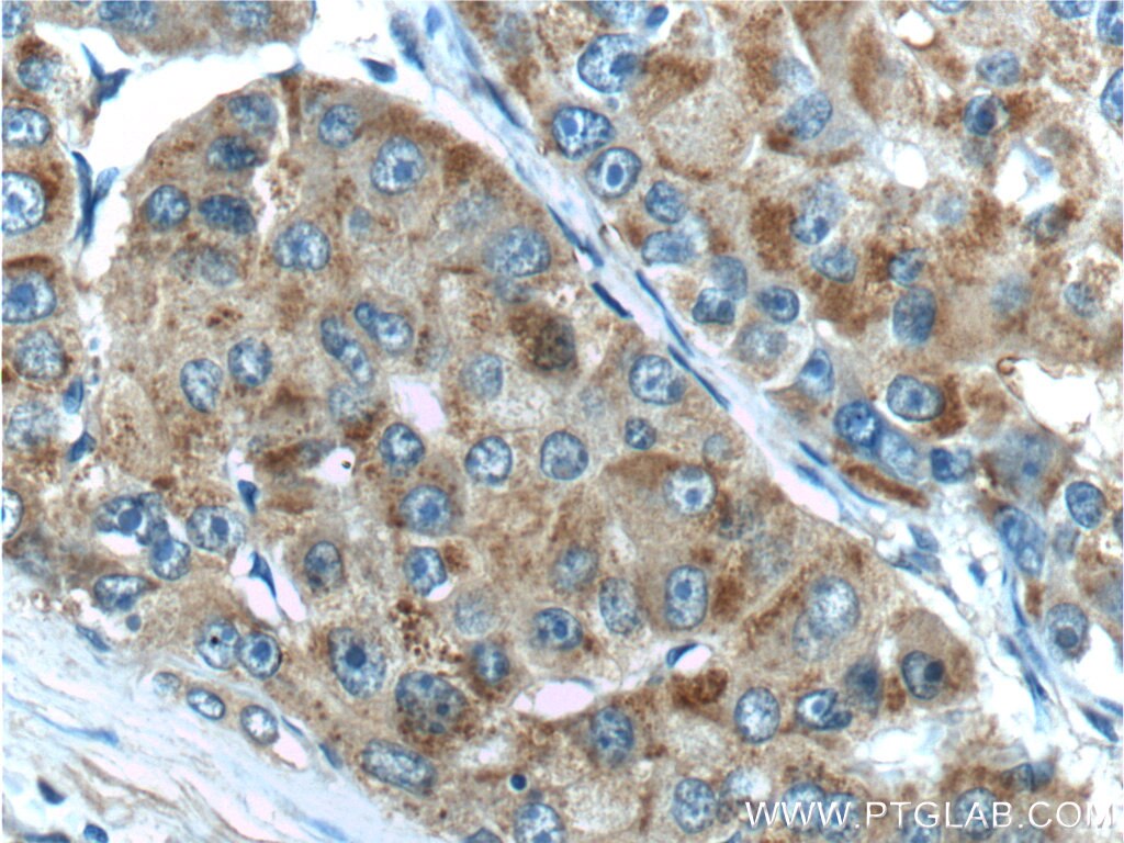 Immunohistochemistry (IHC) staining of human liver cancer tissue using TBC1D17 Polyclonal antibody (20482-1-AP)