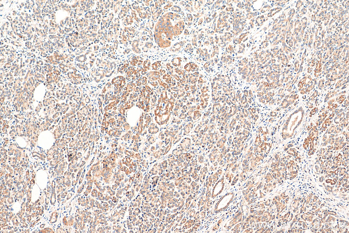 Immunohistochemistry (IHC) staining of human pancreas cancer tissue using TBC1D19 Polyclonal antibody (21085-1-AP)