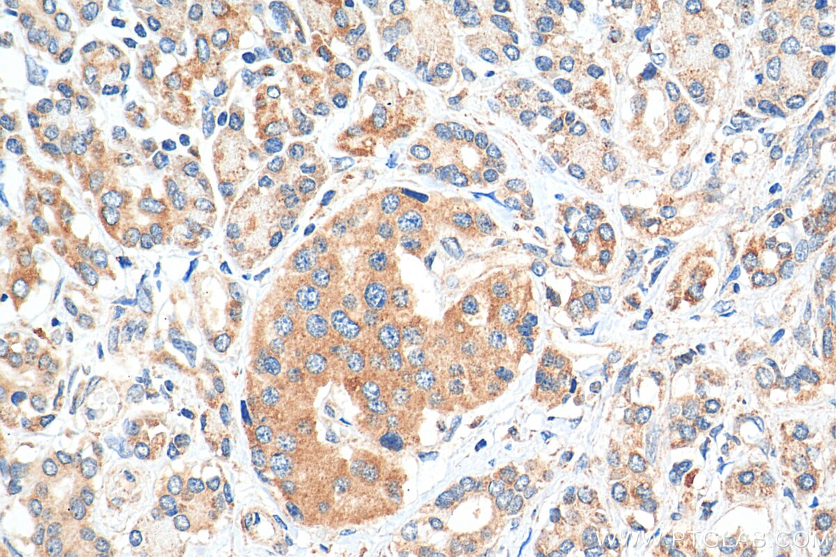 Immunohistochemistry (IHC) staining of human pancreas cancer tissue using TBC1D19 Polyclonal antibody (21085-1-AP)