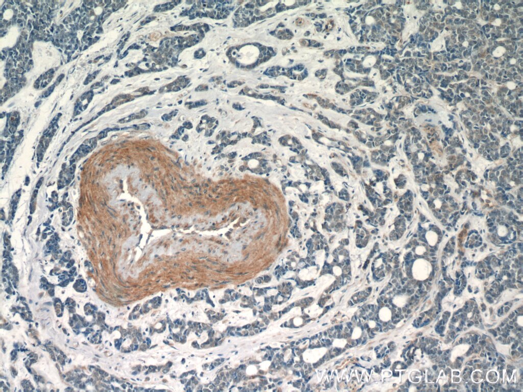 Immunohistochemistry (IHC) staining of human cervical cancer tissue using TBC1D22A Polyclonal antibody (18332-1-AP)