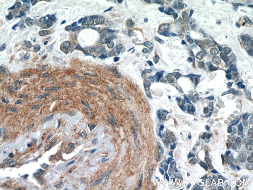 Immunohistochemistry (IHC) staining of human cervical cancer tissue using TBC1D22A Polyclonal antibody (18332-1-AP)