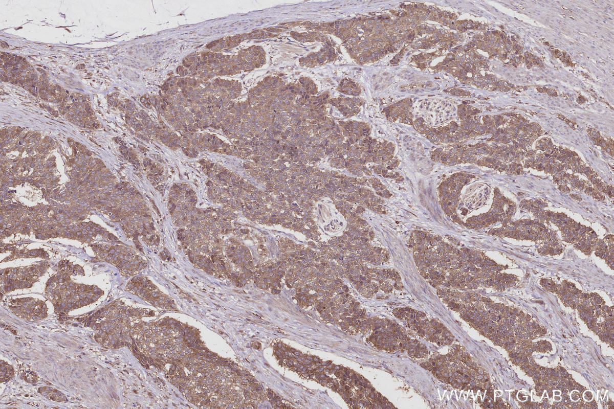 Immunohistochemistry (IHC) staining of human stomach cancer tissue using TBC1D23 Polyclonal antibody (17002-1-AP)