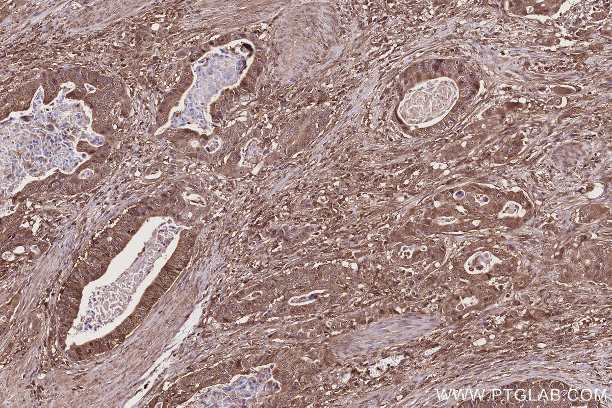 Immunohistochemistry (IHC) staining of human stomach cancer tissue using TBC1D5 Polyclonal antibody (17078-1-AP)