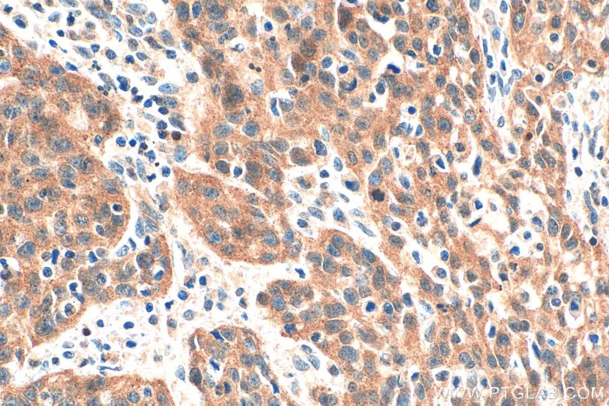 IHC staining of human cervical cancer using 33583-1-AP Immunohistochemistry (IHC) staining of human cervical cancer tissue using TBC1D8 Polyclonal antibody (33583-1-AP)